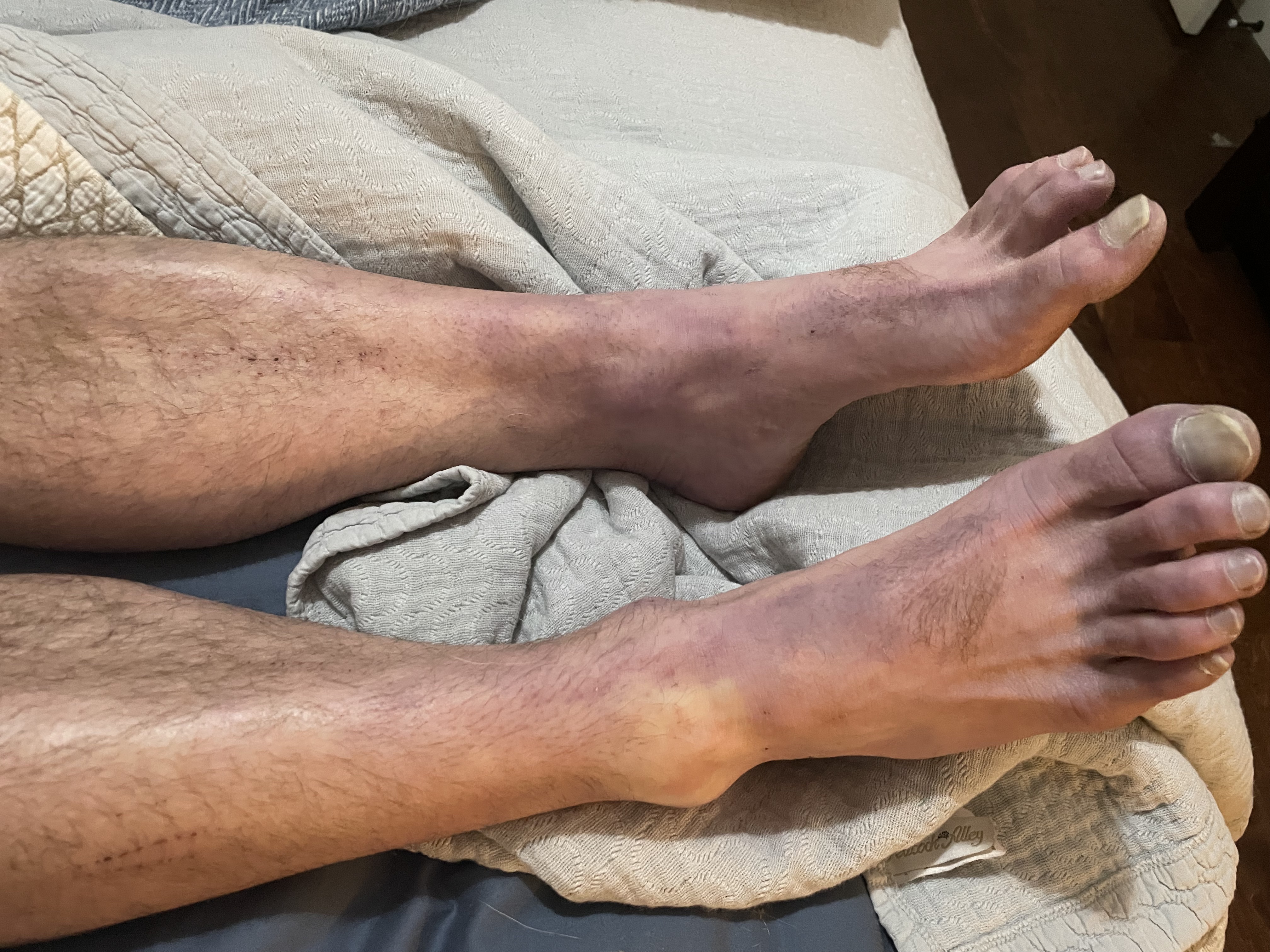 Discoloration of feet